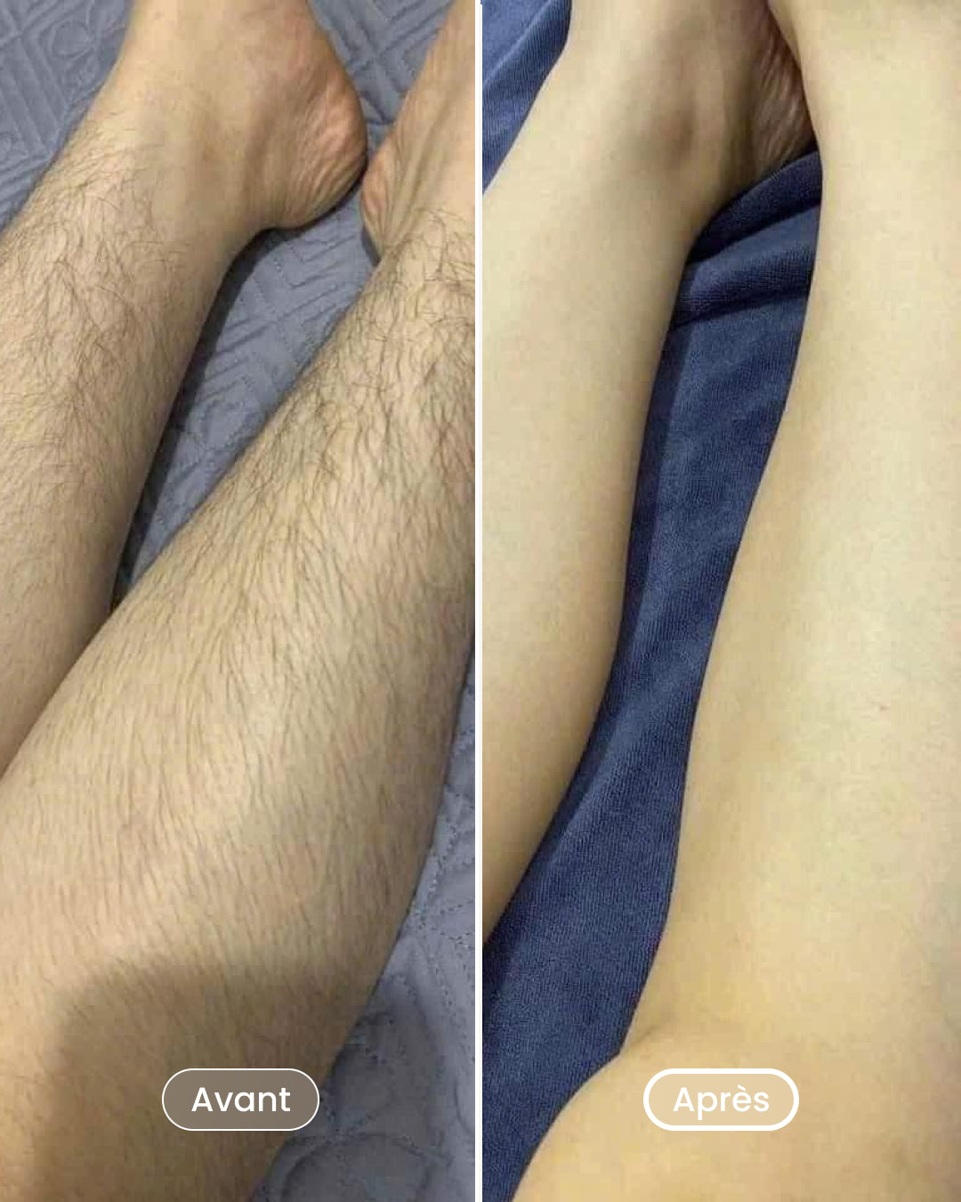 Laser hair removal pack 8 sessions