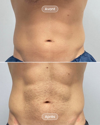 Laser hair removal pack 8 sessions