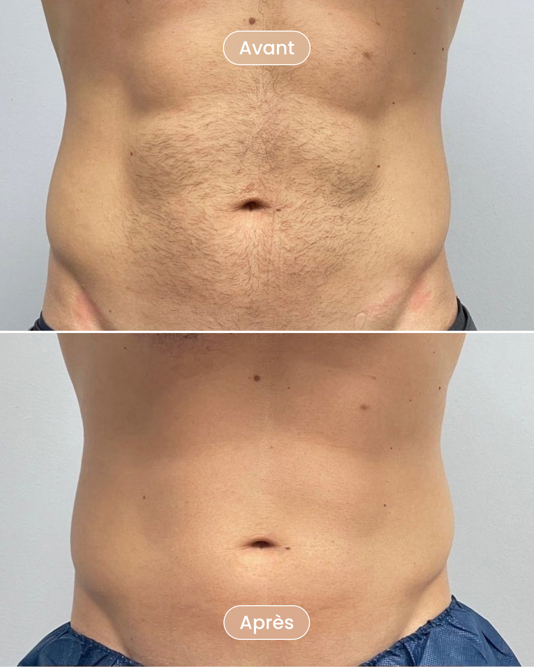 Choisissez vos zones de traitement