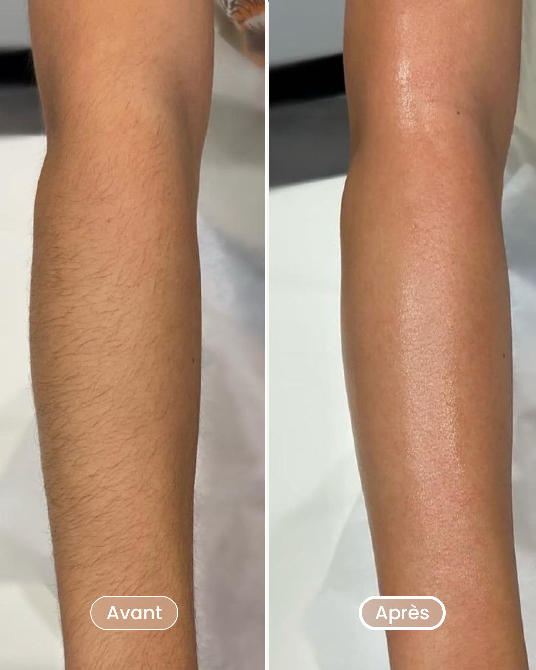 Laser hair removal pack 8 sessions