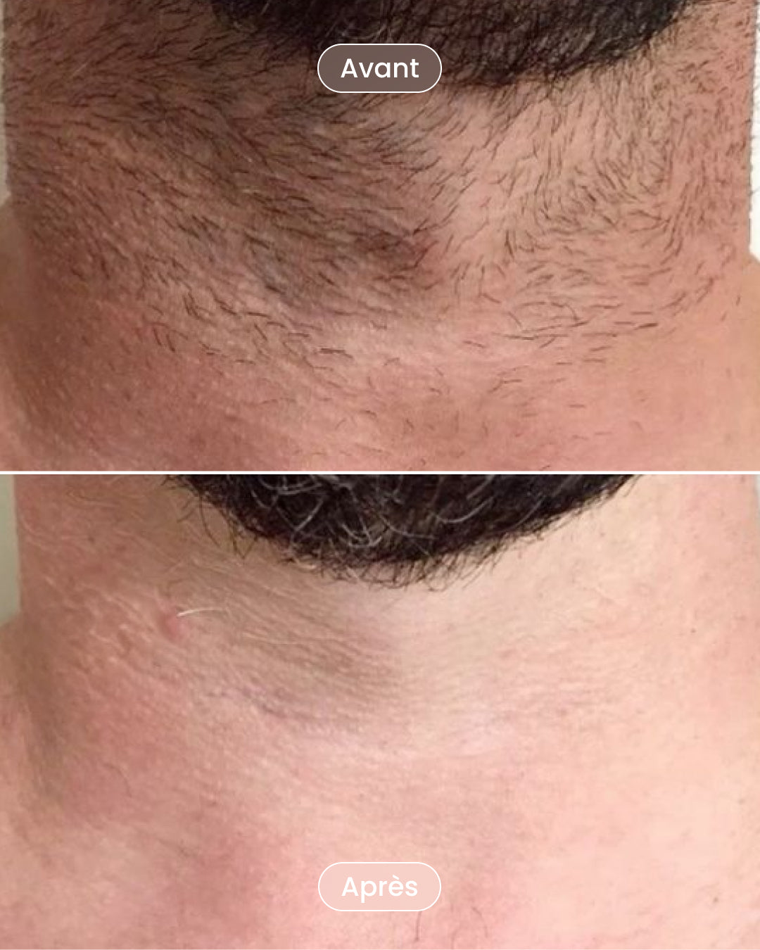 Laser hair removal pack 8 sessions