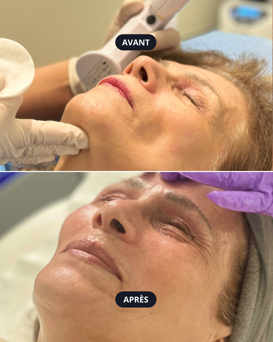 Lifting treatment