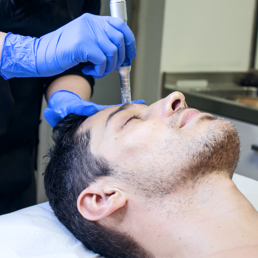 Microneedling visage Genève