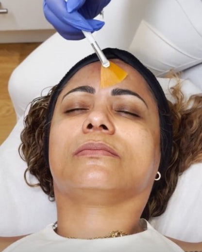 Peeling + Microneedling Treatment