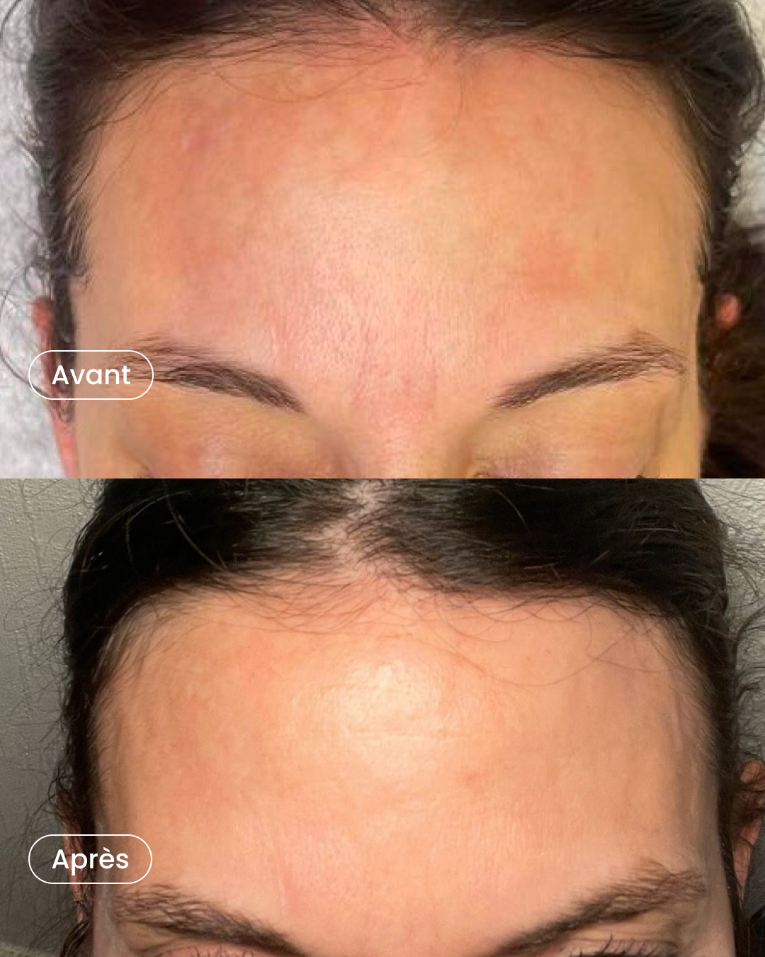Microneedling OR mesotherapy package (your choice) + peeling + light therapy