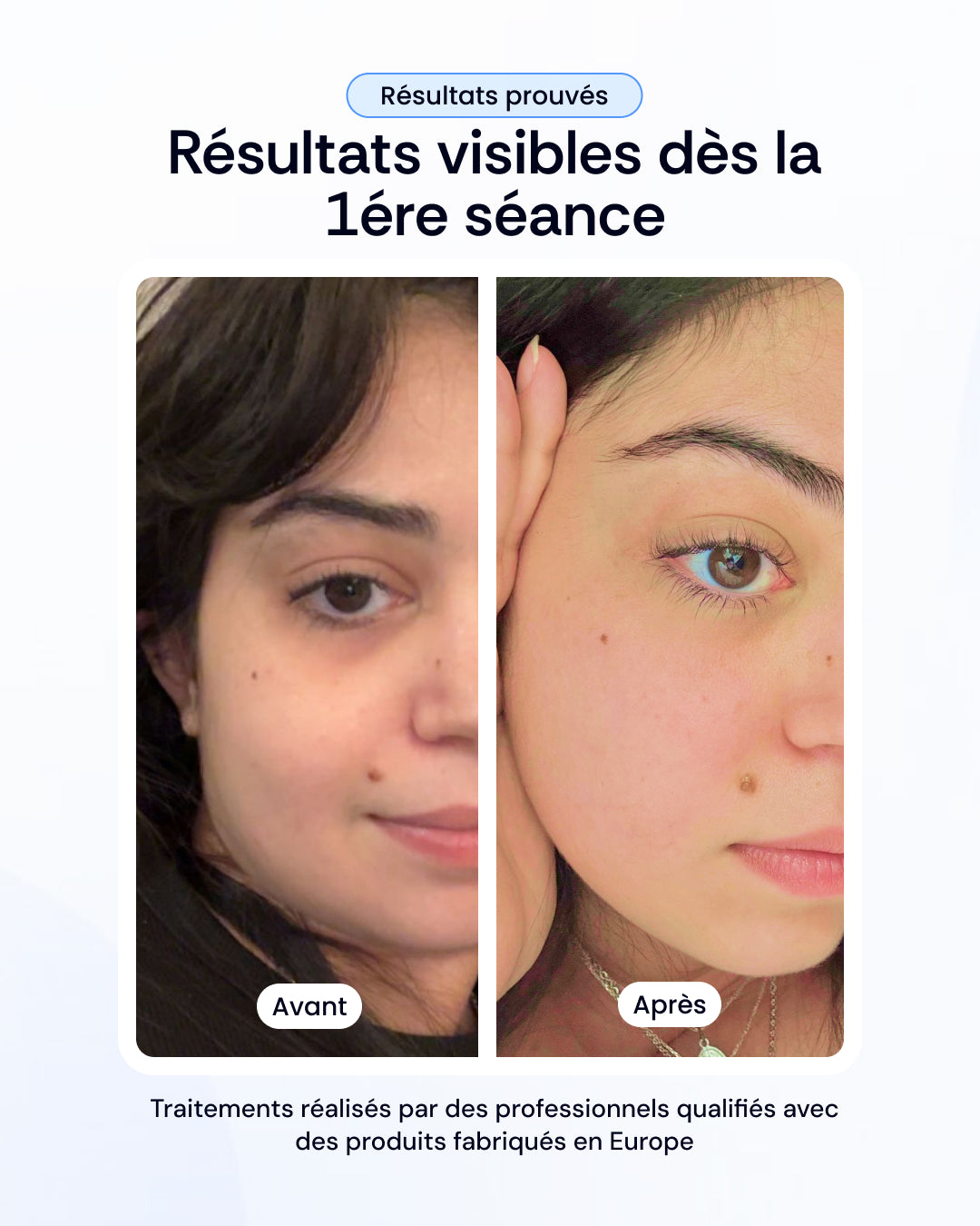 Pack mésothérapie aux exosomes visage
