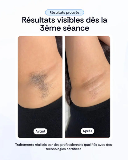 Votre pack d'épilation laser à