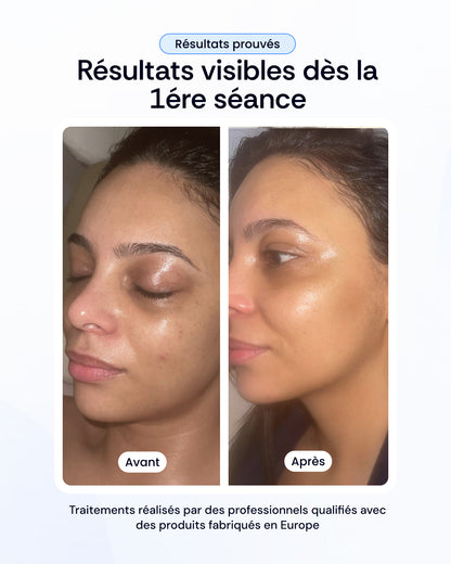 Pack mésothérapie aux exosomes visage