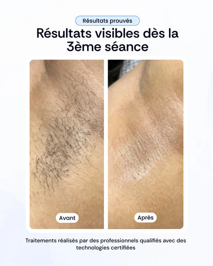 Votre pack d'épilation laser à