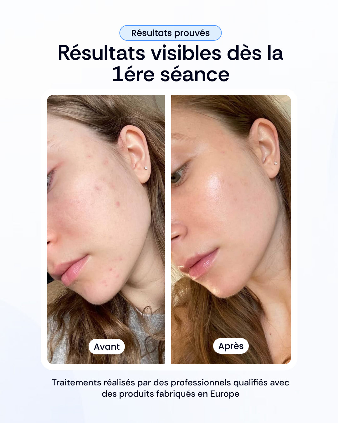 Pack mésothérapie aux exosomes visage