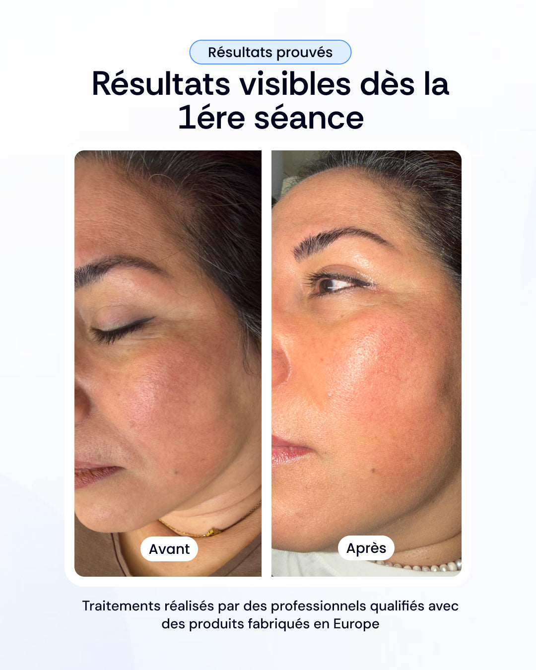 Pack nettoyage profond, peeling & luminothérapie visage
