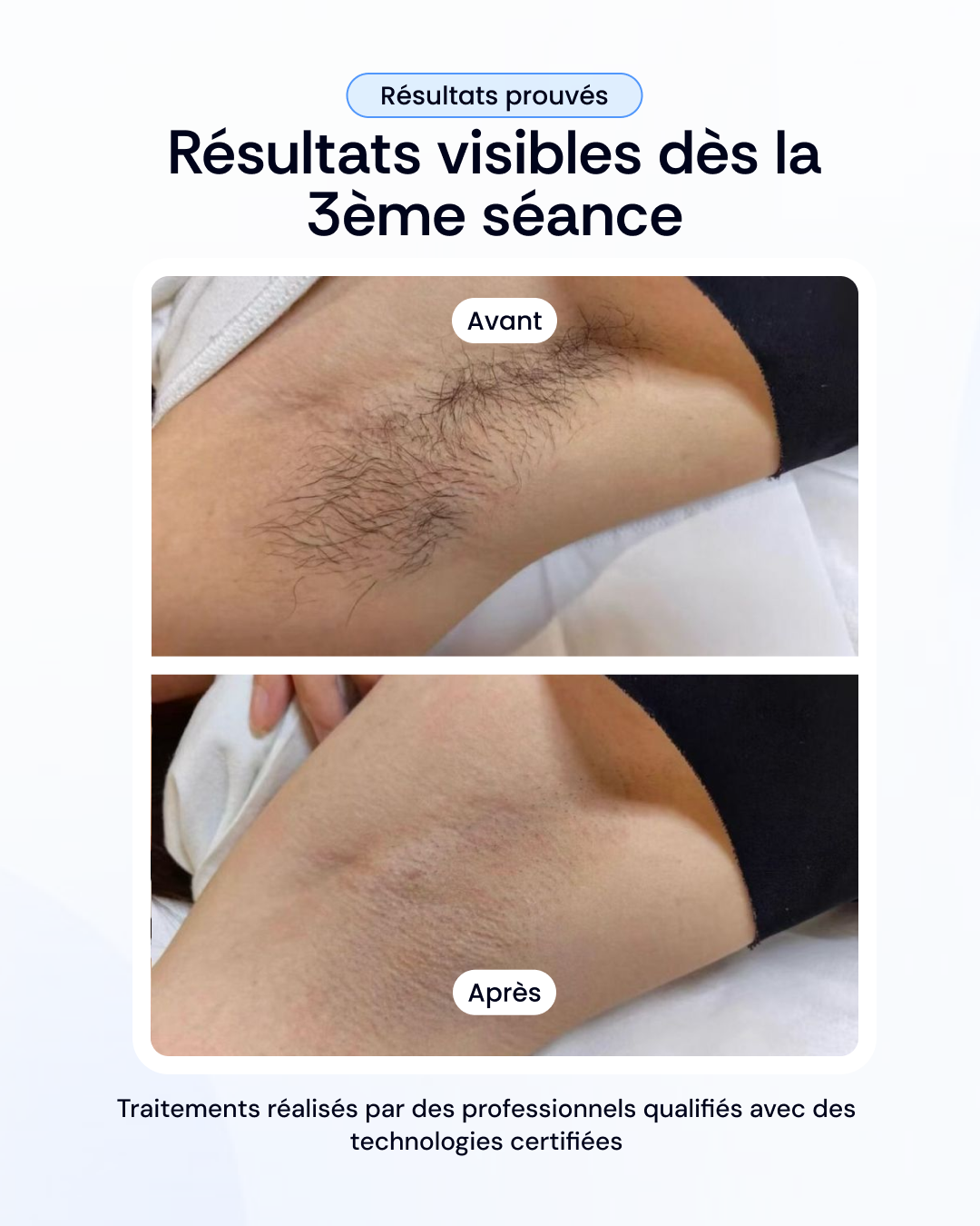 Vos 3 séances d'épilation laser à