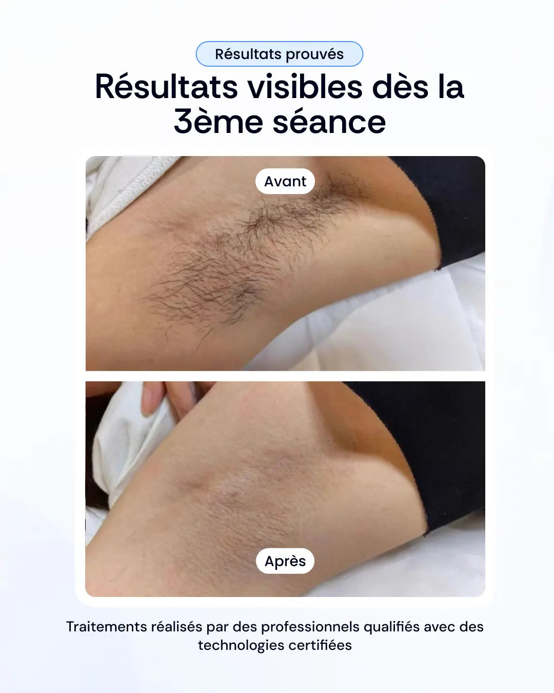 Votre pack d'épilation laser à