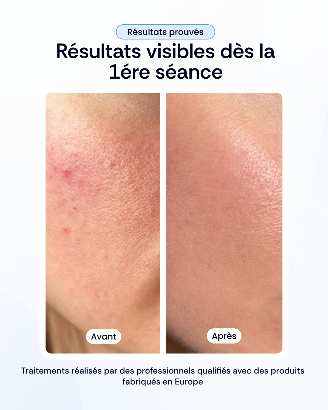 Peeling + Mésothérapy + Light Therapy Treatment