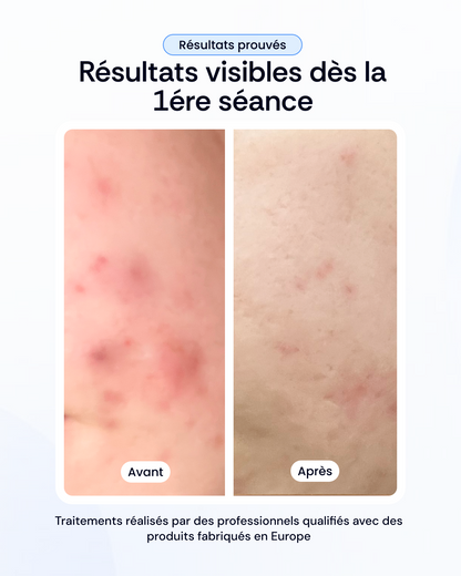 Peeling + Mésothérapy + Light Therapy Treatment