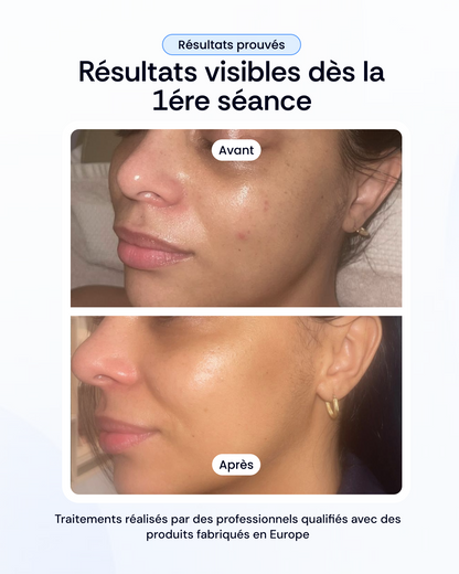 Peeling + Mésothérapy + Light Therapy Treatment