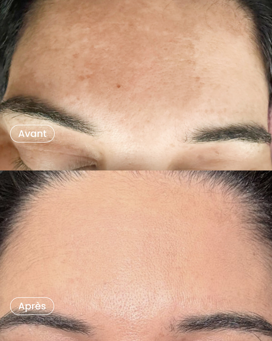 Radiance treatment 