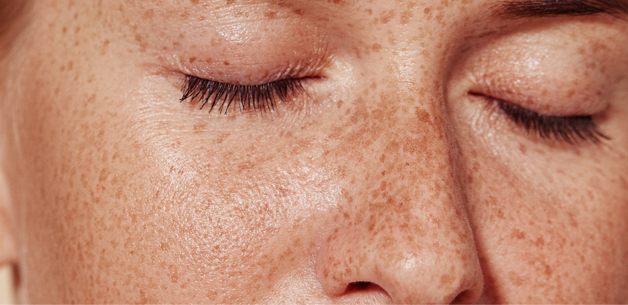 Taches de rousseur ou éphélides sur les joues