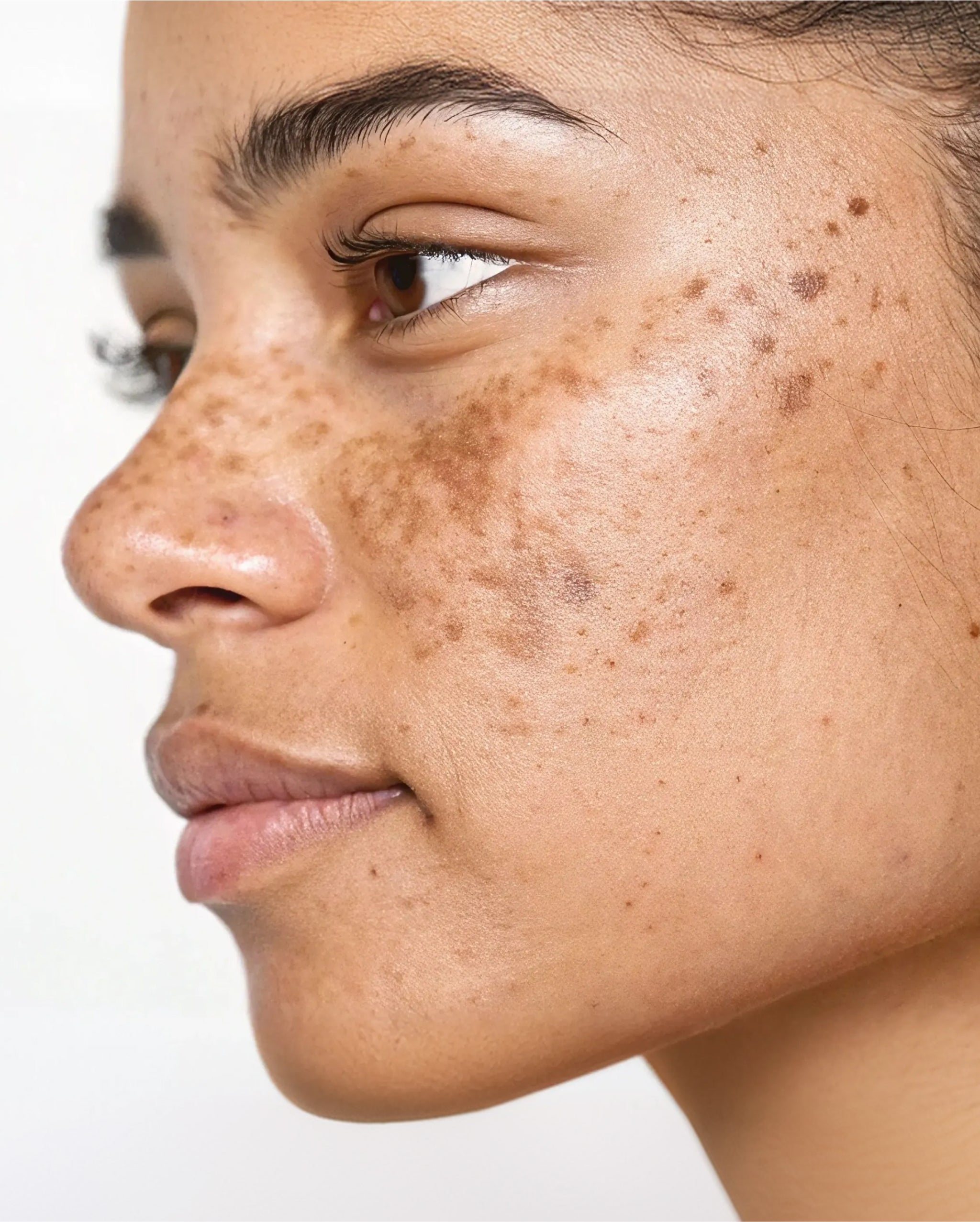 Visage marqué par des taches pigmentaires brunes